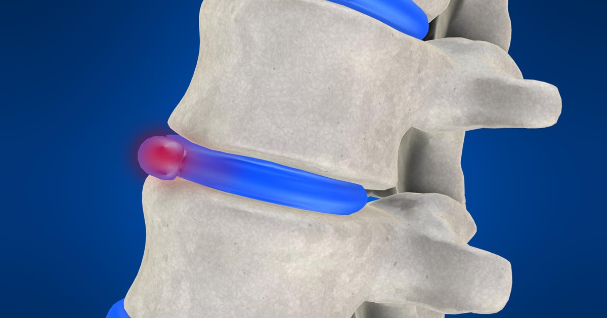 Alexandria, KY non-surgical disc herniation treatment